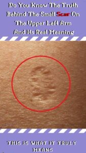 This Is The Truth Behind The Scar Everyone Has On The Upper Left Arm!
